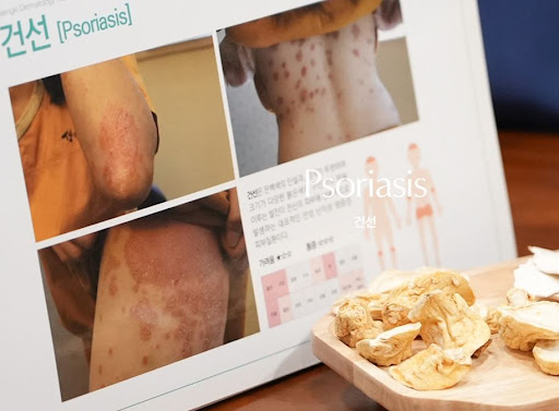 생기한의원이 안내하는 건선 증상 부위별 피부 변화 특징